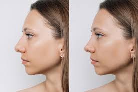 Discover the Benefits of Rhinoplasty in Dubai: Enhance Your Natural Beauty Rhinoplasty